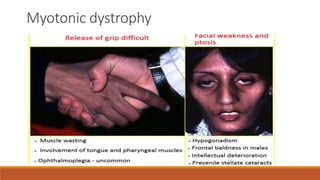 Myotonic dystrophy
 
