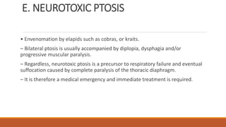 E. NEUROTOXIC PTOSIS
• Envenomation by elapids such as cobras, or kraits.
– Bilateral ptosis is usually accompanied by diplopia, dysphagia and/or
progressive muscular paralysis.
– Regardless, neurotoxic ptosis is a precursor to respiratory failure and eventual
suffocation caused by complete paralysis of the thoracic diaphragm.
– It is therefore a medical emergency and immediate treatment is required.
 