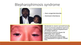 Blepharophimosis syndrome
 