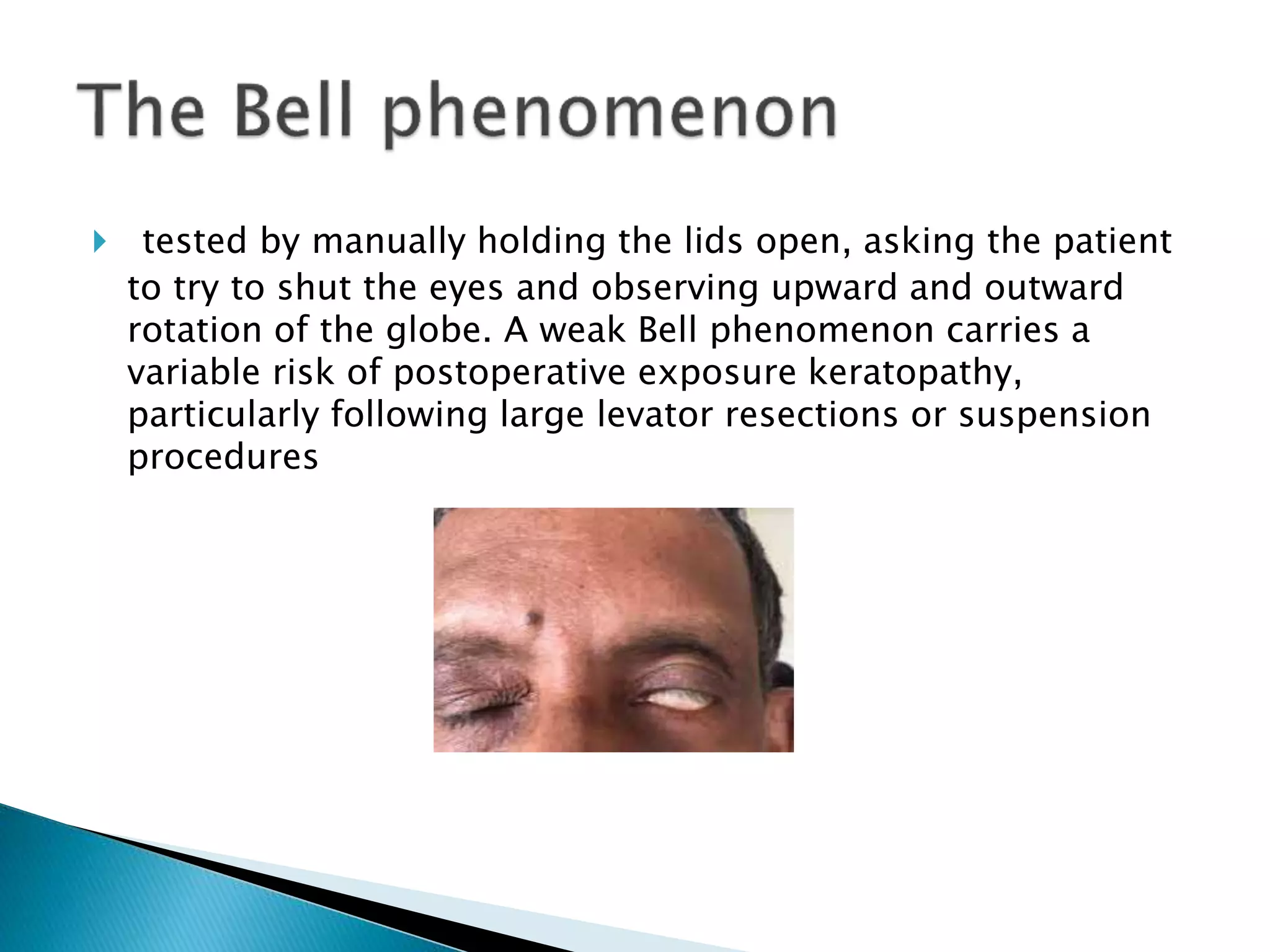 Ptosis eyelid disorders | PPTX