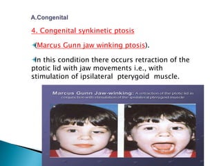 4. Congenital synkinetic ptosis
(Marcus Gunn jaw winking ptosis).
In this condition there occurs retraction of the
ptotic lid with jaw movements i.e., with
stimulation of ipsilateral pterygoid muscle.
 