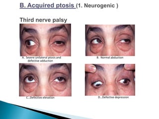 C…Defective elevation D…Defective depression
B. Normal abductionA. Severe unilateral ptosis and
defective adduction
 