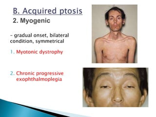 – gradual onset, bilateral
condition, symmetrical
1. Myotonic dystrophy
2. Chronic progressive
exophthalmoplegia
 