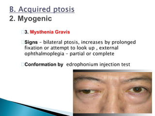 3. Mysthenia Gravis
Signs – bilateral ptosis, increases by prolonged
fixation or attempt to look up , external
ophthalmoplegia – partial or complete
Conformation by edrophonium injection test
 
