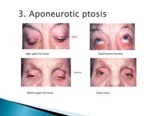 High upper lid crease Good levator function
Deep sulcusAbsent upper lid crease
Mild
Severe
 