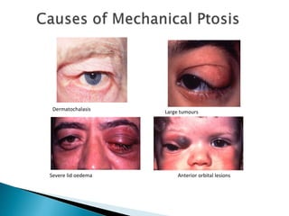 Dermatochalasis Large tumours
Anterior orbital lesionsSevere lid oedema
 
