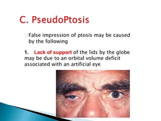 False impression of ptosis may be caused
by the following
1. Lack of support of the lids by the globe
may be due to an orbital volume deficit
associated with an artificial eye
 