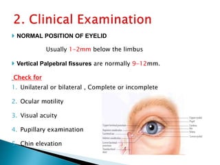  NORMAL POSITION OF EYELID
Usually 1-2mm below the limbus
 Vertical Palpebral fissures are normally 9-12mm.
Check for
1. Unilateral or bilateral , Complete or incomplete
2. Ocular motility
3. Visual acuity
4. Pupillary examination
5. Chin elevation
 