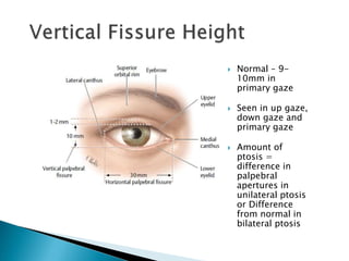  Normal – 9-
10mm in
primary gaze
 Seen in up gaze,
down gaze and
primary gaze
 Amount of
ptosis =
difference in
palpebral
apertures in
unilateral ptosis
or Difference
from normal in
bilateral ptosis
 