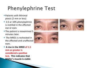 Patients with Minimal
ptosis (2 mm or less)
 2.5 or 10% phenylephrine
is instilled in the affected
eye or eyes
The patient is reexamined 5
minutes later.
 The MRD1 is rechecked in
the affected and unaffected
eyes .
 A rise in the MRDl of 1.5
mm or greater is
considered a positive
test. This indicates that
Müller's muscle is viable
 