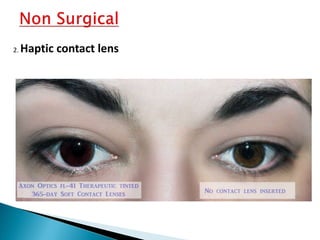 2. Haptic contact lens
 