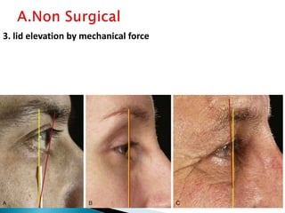 3. lid elevation by mechanical force
 