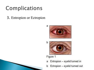 3. Entropion or Ectropion
 