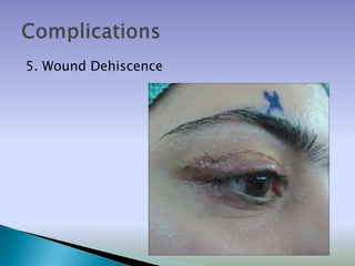 5. Wound Dehiscence
 