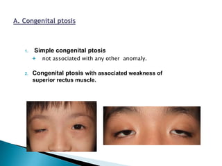 1. Simple congenital ptosis
 not associated with any other anomaly.
2. Congenital ptosis with associated weakness of
superior rectus muscle.
 