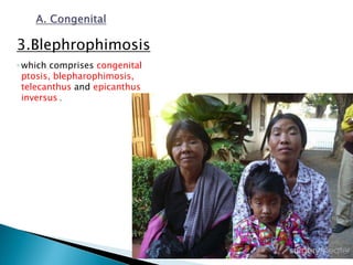 3.Blephrophimosis
◦ which comprises congenital
ptosis, blepharophimosis,
telecanthus and epicanthus
inversus .
 