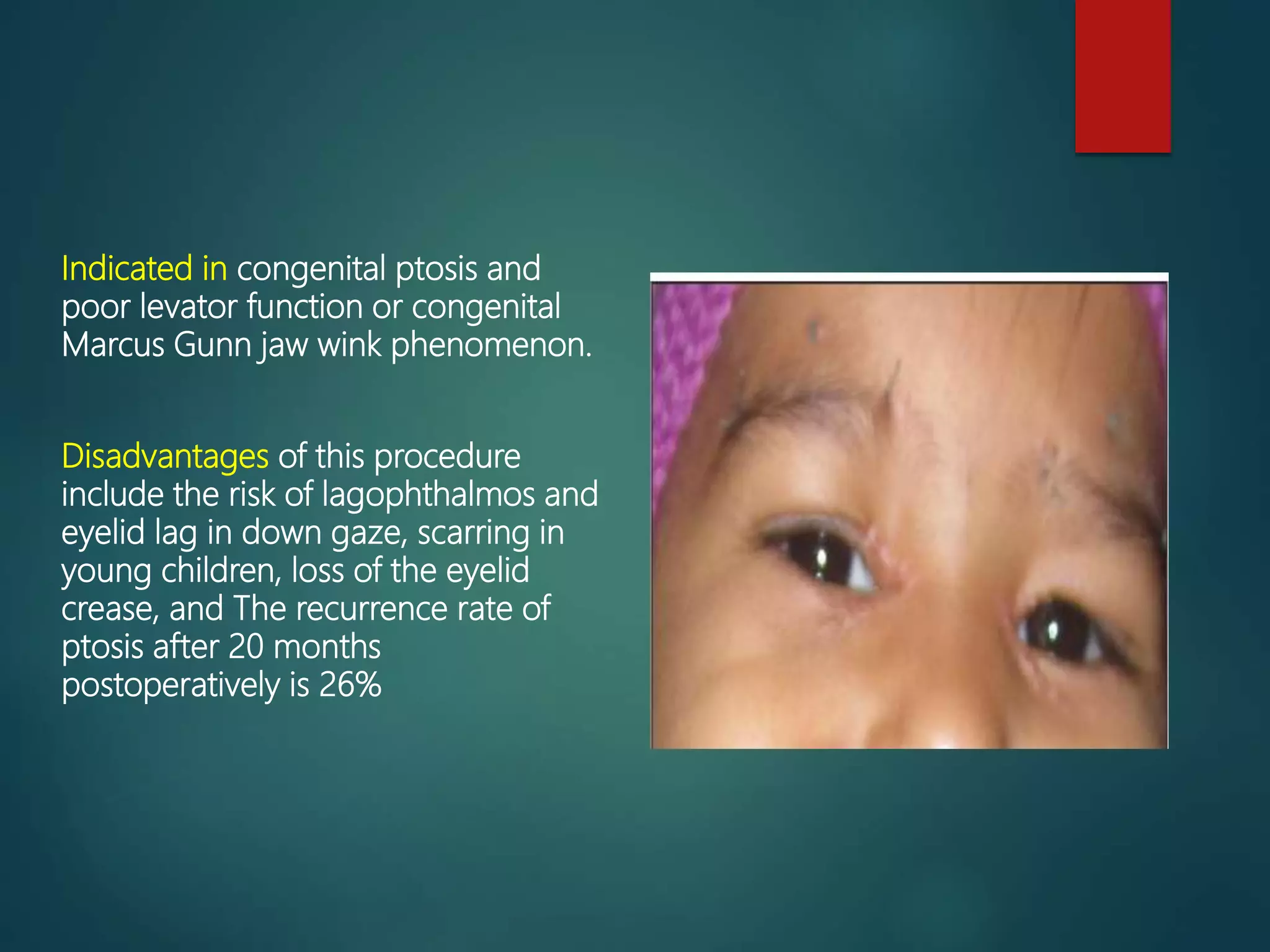 Ptosis | PPT