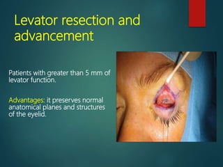 Levator Function Testing Ptosis | PPTX