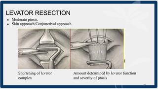 Ptosis, Definition,Clinical Features,Management | PDF