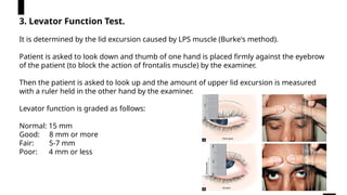 Normal Levator Function Comprehensive Overview of Ptosis: Anatomy, Types, Diagnosis, and ...