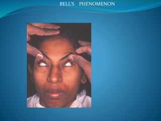 Ptosis bdm copy | PPTX