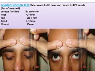 Comprehensive Evaluation and Management of Ptosis in Ophthalmology | PPTX