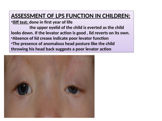 Levator Function Testing Comprehensive Evaluation and Management of Ptosis in Ophthalmology | PPTX