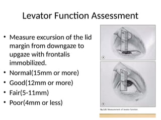 Normal Levator Function Ptosis_MS_Ophthalmology_Presentation 6.pptx