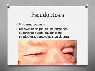 Pseudoptosis
O 5.- dermatocalasia
O Un exceso de piel en los parpados
superiores puede causar tanto
seudoptosis como ptosis verdadera
 