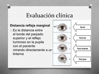 Evaluación clínica
Distancia refleja marginal
O Es la distancia entre
el borde del parpado
superior y el reflejo
luminoso en la pupila
con el paciente
mirando directamente a una
linterna
 