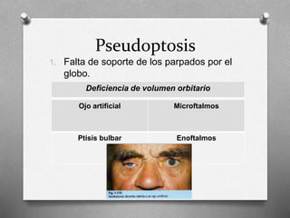 Pseudoptosis
1. Falta de soporte de los parpados por el
globo.
Ojo artificial Microftalmos
Ptisis bulbar Enoftalmos
Deficiencia de volumen orbitario
 