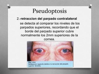 Pseudoptosis
2.-retraccion del parpado contralateral
se detecta al comparar los niveles de los
parpados superiores, recordando que el
borde del parpado superior cubre
normalmente los 2mm superiores de la
cornea.
 
