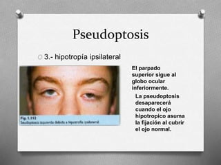 Pseudoptosis
O 3.- hipotropía ipsilateral
O El parpado
superior sigue al
globo ocular
inferiormente.
La pseudoptosis
desaparecerá
cuando el ojo
hipotropico asuma
la fijación al cubrir
el ojo normal.
 