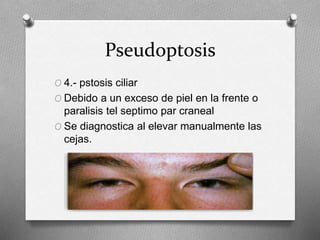 Pseudoptosis
O 4.- pstosis ciliar
O Debido a un exceso de piel en la frente o
paralisis tel septimo par craneal
O Se diagnostica al elevar manualmente las
cejas.
 