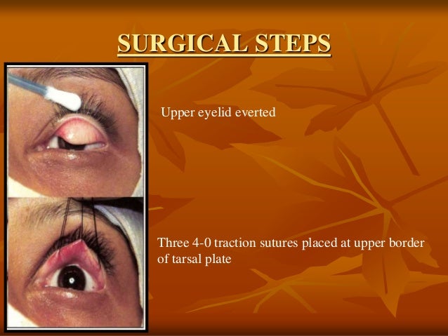 ptosis surgery ptosis surgery