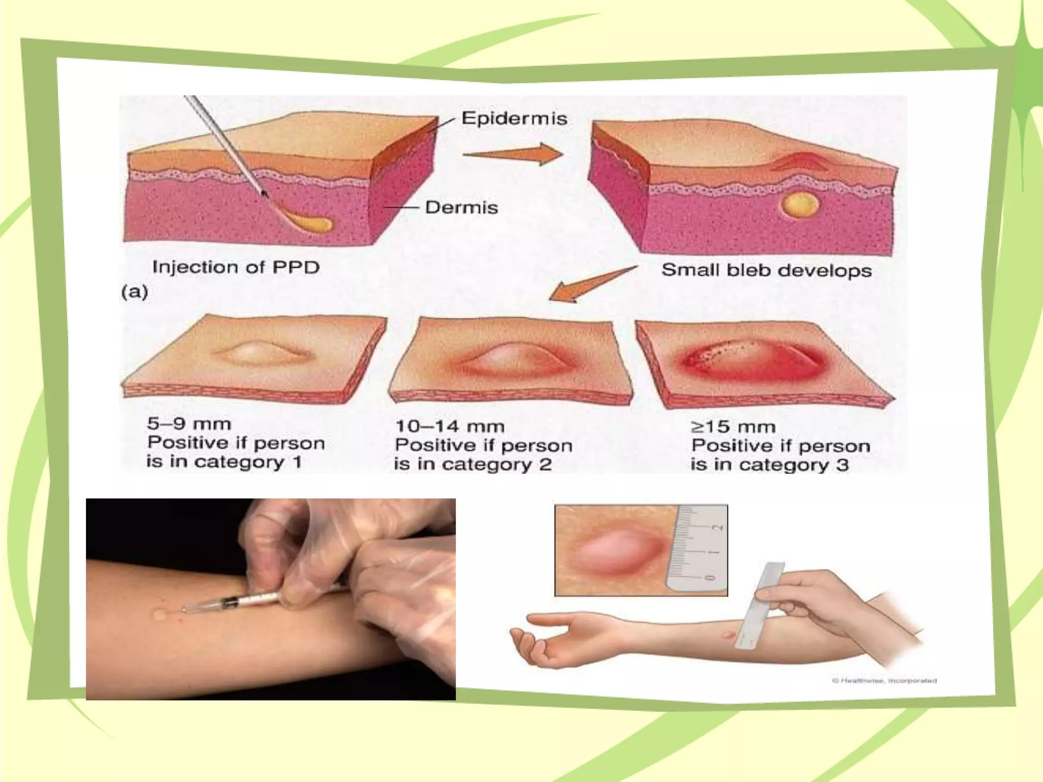 Pulmonary Tuberculosis - Phthisis[1].pptx