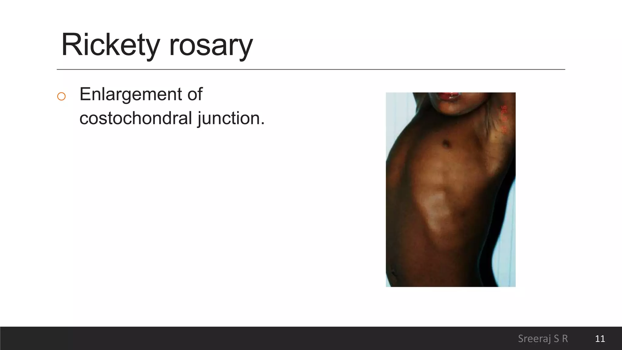 Physiotherapy for Rickets and Osteomalacia | PPTX