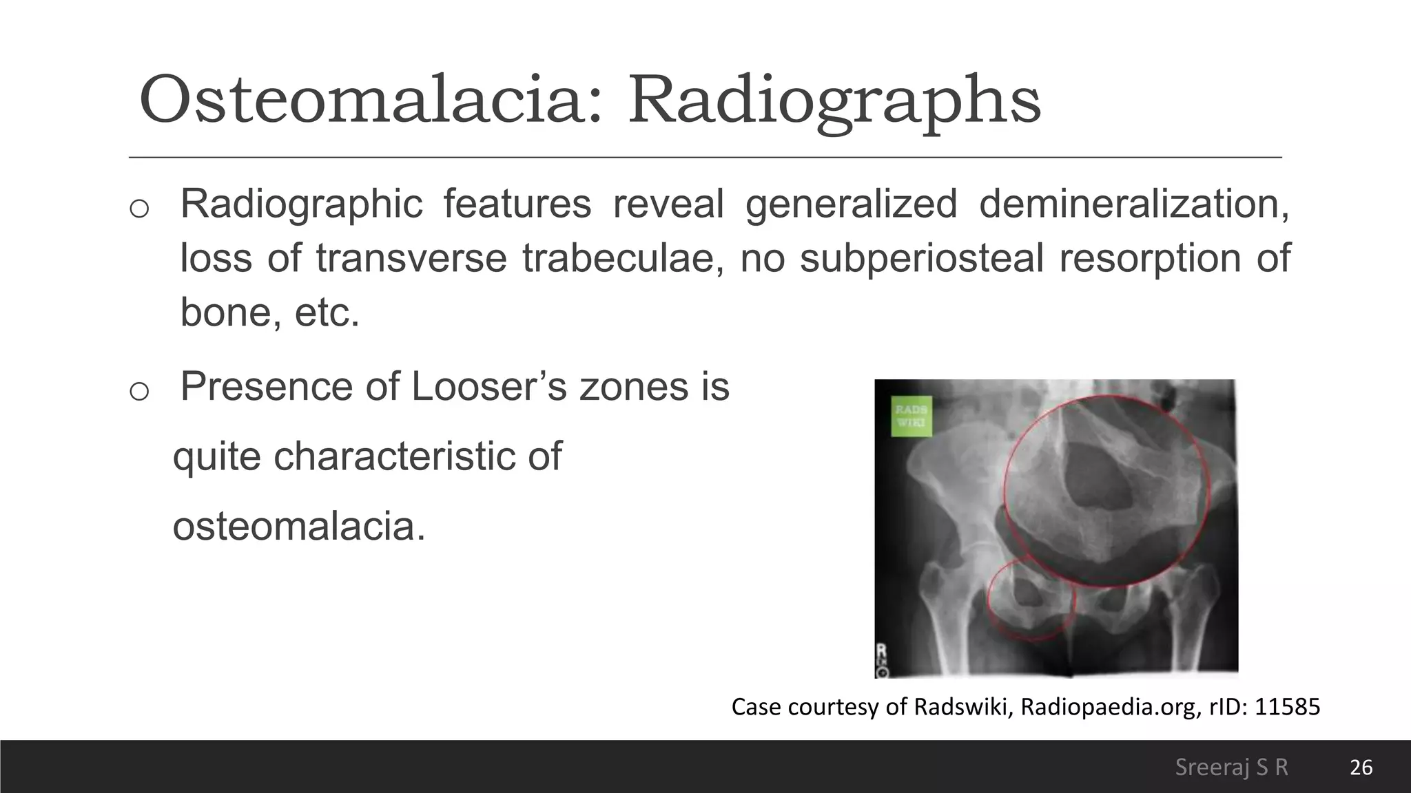 Physiotherapy for Rickets and Osteomalacia | PPTX