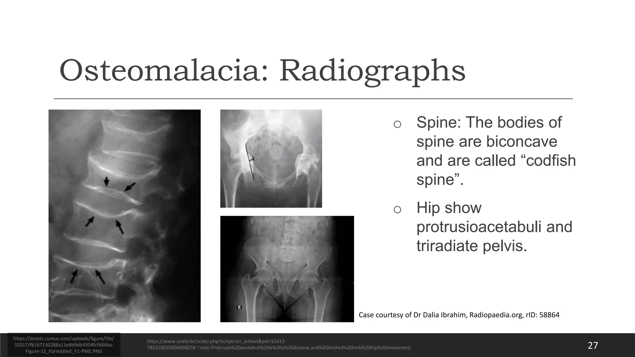 Physiotherapy for Rickets and Osteomalacia | PPTX