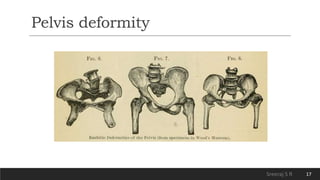 Physiotherapy for Rickets and Osteomalacia | PPTX