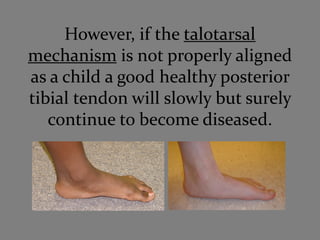 However, if the talotarsal
mechanism is not properly aligned
as a child a good healthy posterior
tibial tendon will slowly but surely
   continue to become diseased.
 