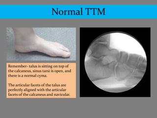 Normal TTM




Remember- talus is sitting on top of
the calcaneus, sinus tarsi is open, and
there is a normal cyma.

The articular facets of the talus are
perfectly aligned with the articular
facets of the calcaneus and navicular.
 