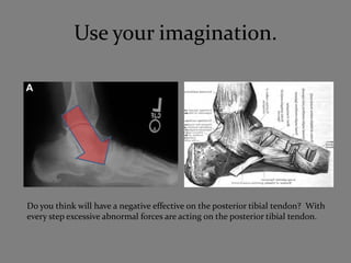 Use your imagination.




Do you think will have a negative effective on the posterior tibial tendon? With
every step excessive abnormal forces are acting on the posterior tibial tendon.
 