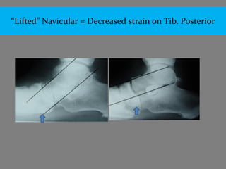 “Lifted” Navicular = Decreased strain on Tib. Posterior
 