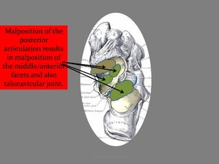 Malposition of the
       posterior
 articulation results
  in malposition of
the middle/anterior
    facets and also
 tal...