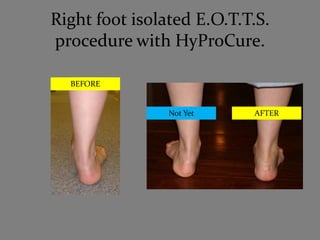 Right foot isolated E.O.T.T.S.
procedure with HyProCure.

  BEFORE


                Not Yet    AFTER
 