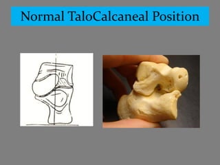 Normal TaloCalcaneal Position
 