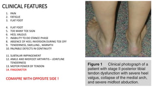 PTTD - Acquired Pes Planus | PDF