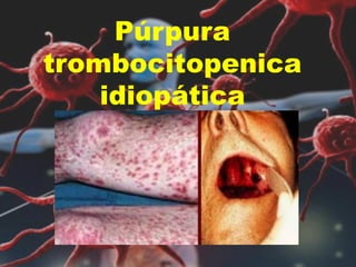 Púrpura
trombocitopenica
idiopática
 