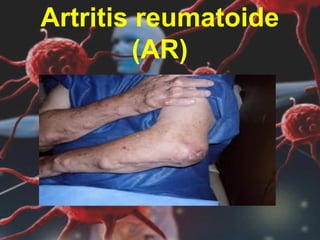 Artritis reumatoide
(AR)
 